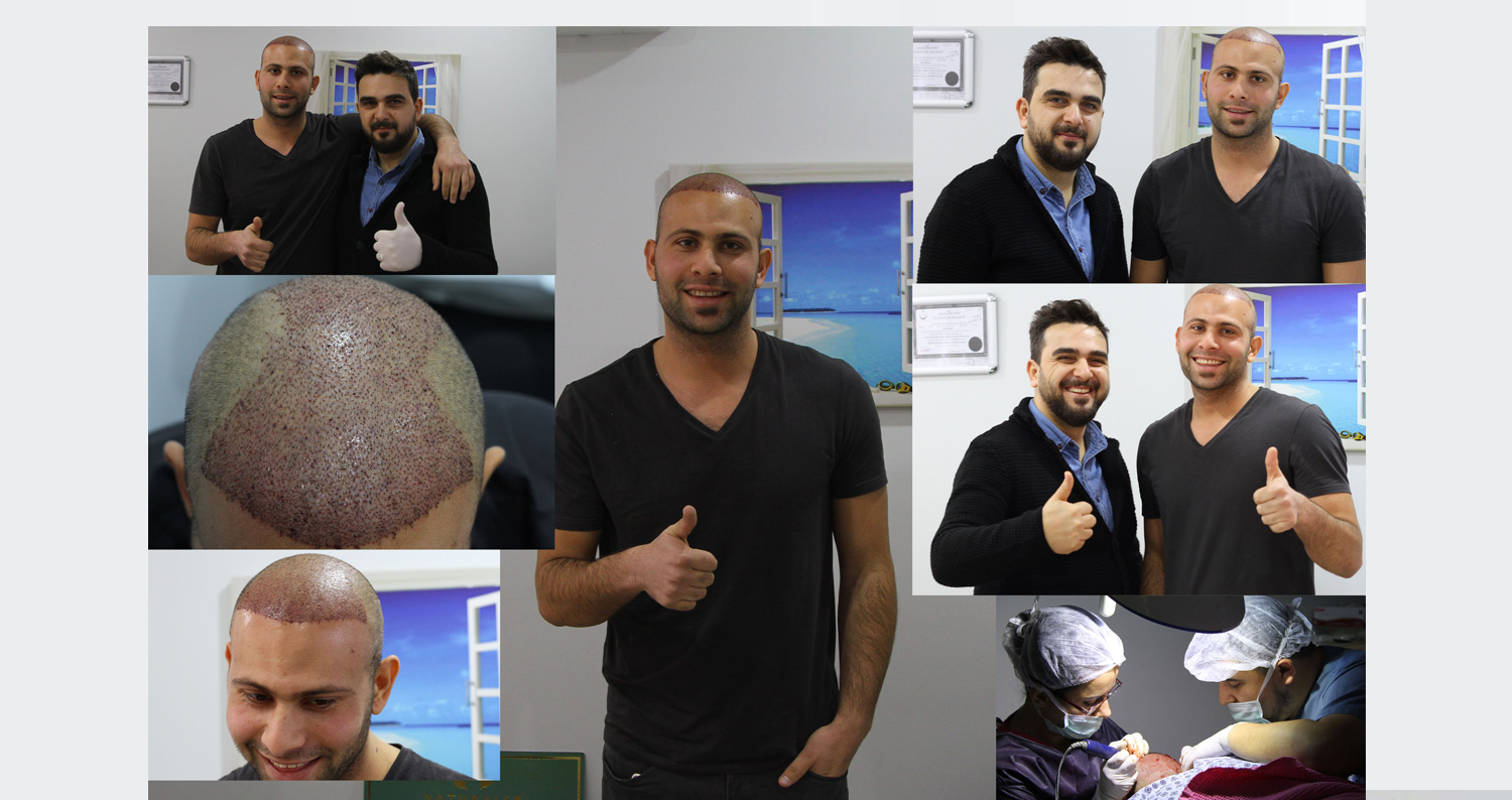 hair transplant in istanbul turkey