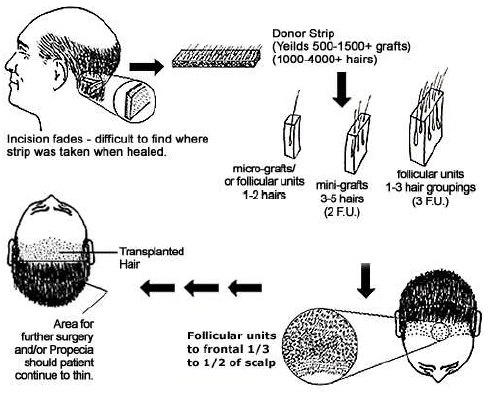 hair transplantation prorocdure diagram