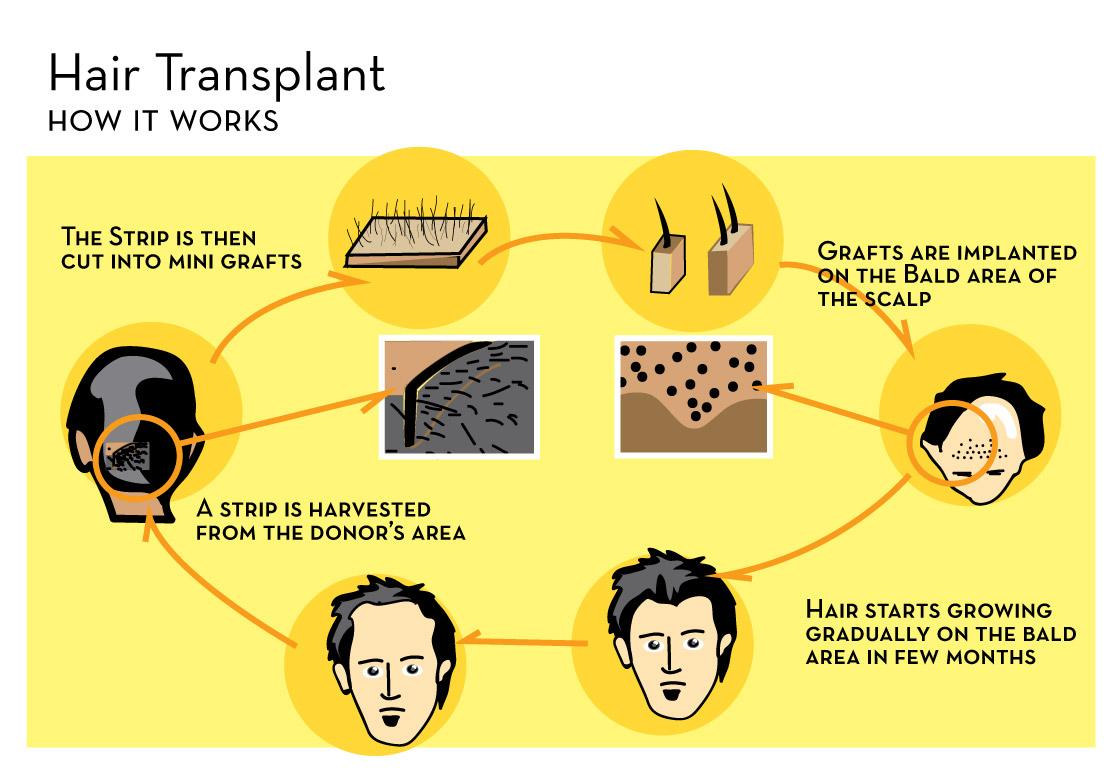 hair transplant in turkey istanbul